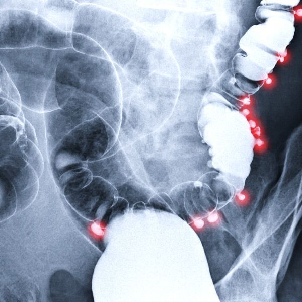Click to Enlarge Diverticulitis