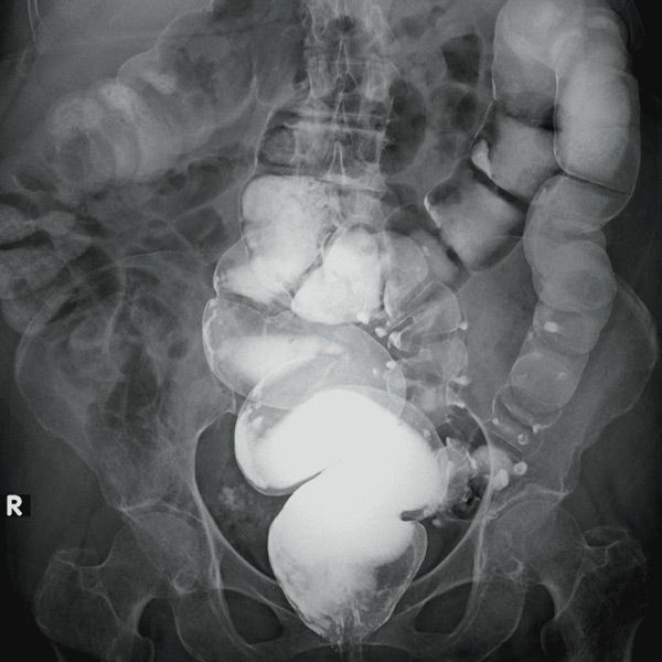 Click to Enlarge Diverticulosis