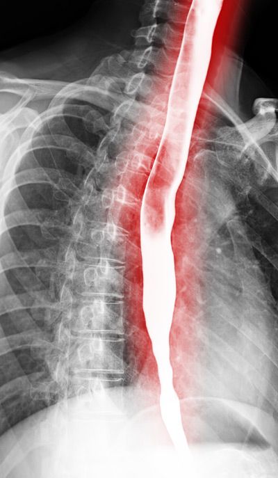 Esophagram or Barium swallow oblique view showing esophagus for diagnosis GERD or Gastroesophageal reflux disease What Are The Symptoms of GERD? What Are The Symptoms of GERD?