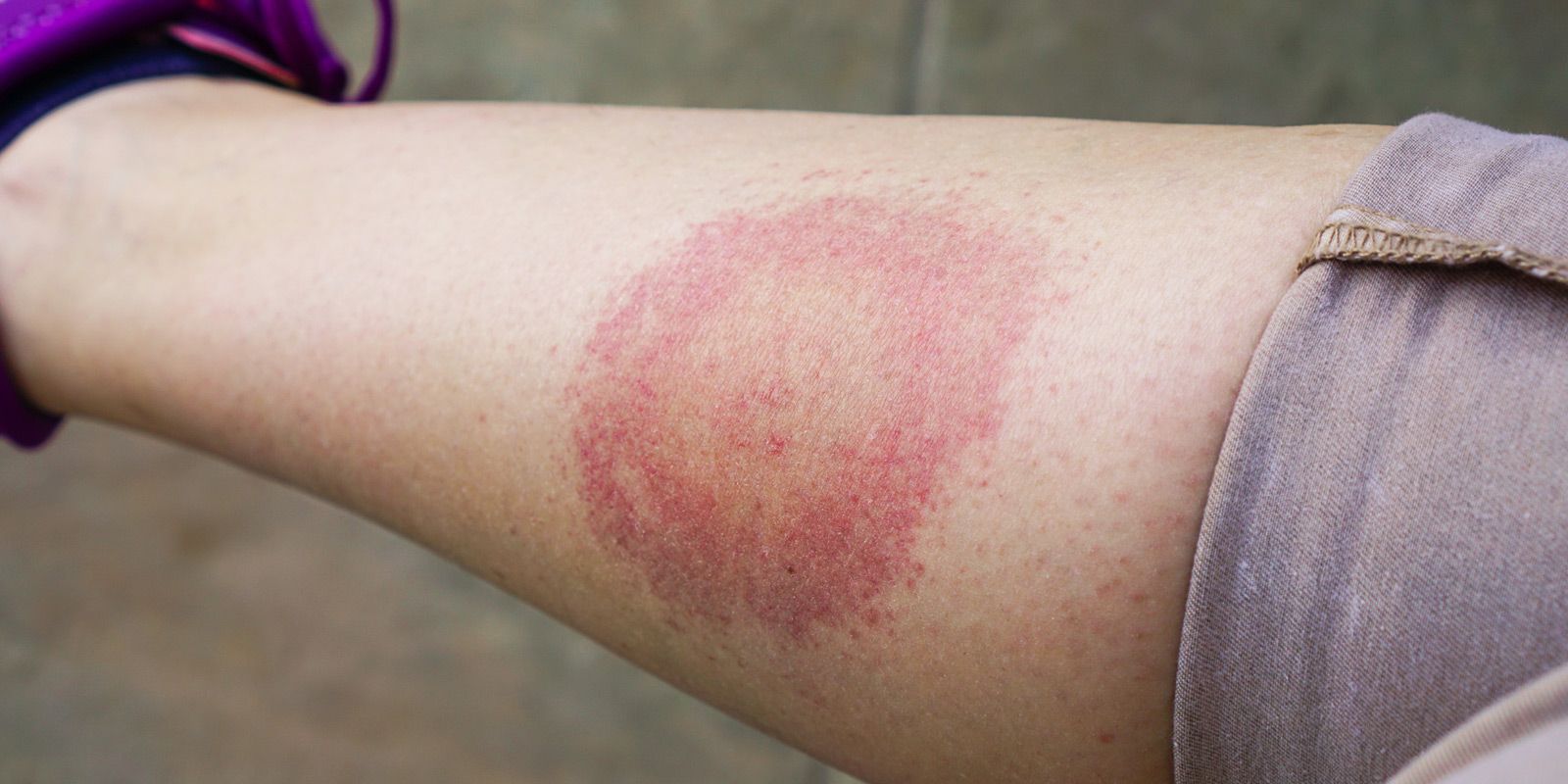 Parasite Infections NYC - Dr. Alicia Armitstead. Natural Parasitic Infection Remedies at Healing Arts NYC Health and Wellness Center in Manhattan NY 10017 and Connecticut