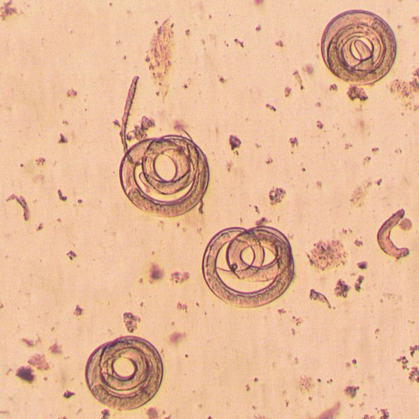 Parasitic Infection Symptoms Diagnosing Parasite Infections