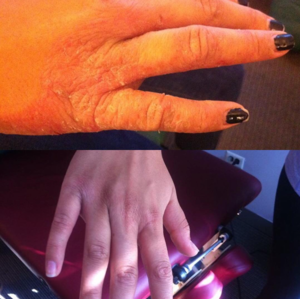 Two hands, one with dry, red skin and black nail polish, the other with smooth skin and nail clipper.