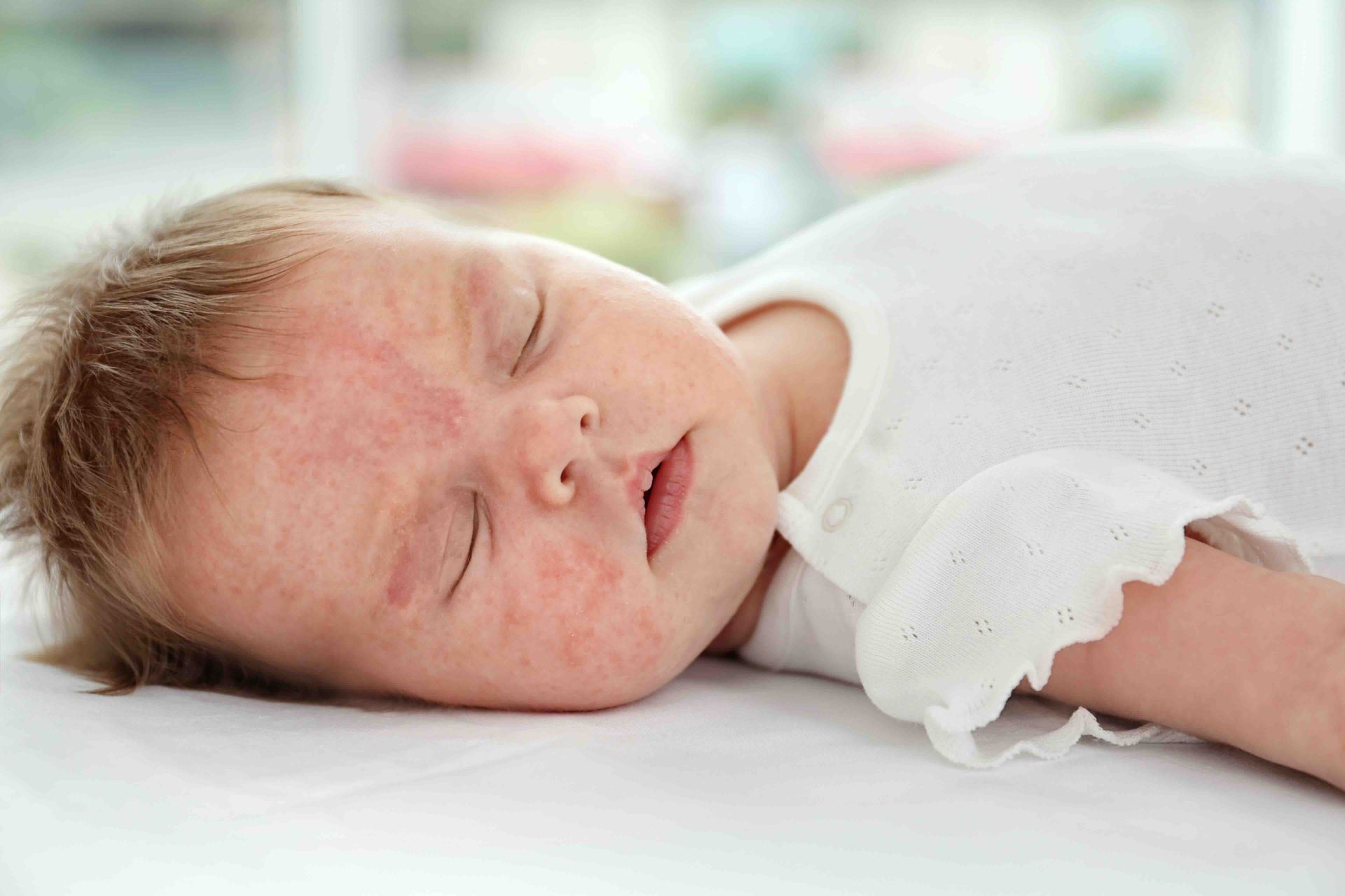 A baby with red spots on his face is sleeping on a bed.