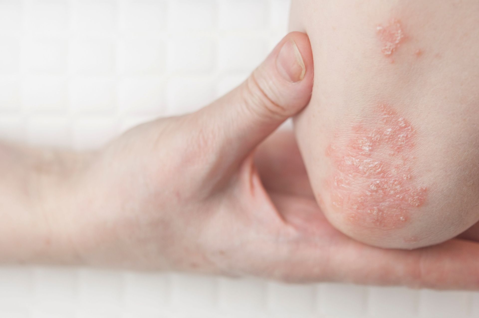 A person is holding a baby 's elbow with a rash on it.