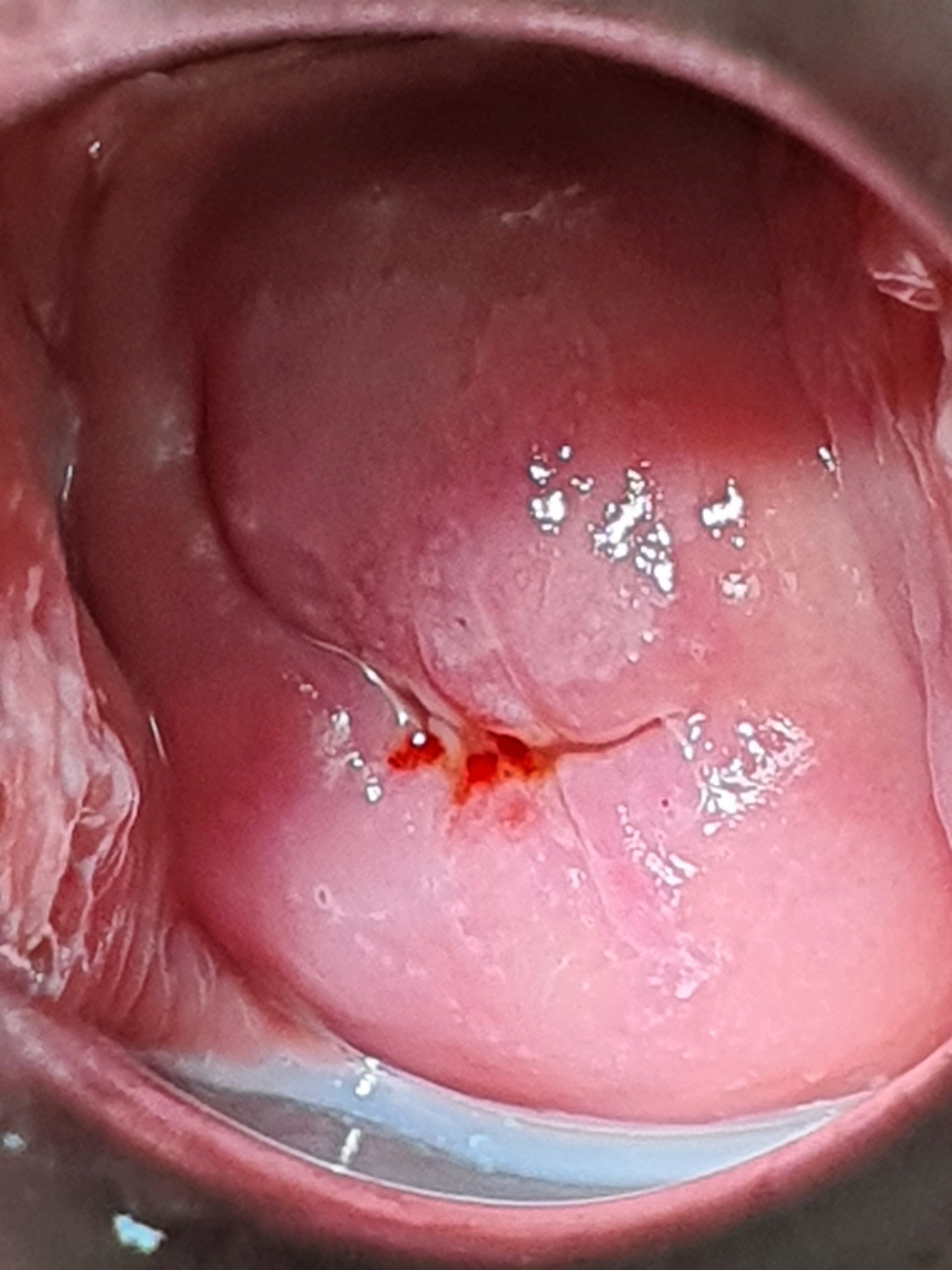 COLPOSCOPIA