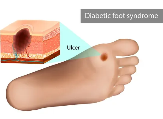 Schema della sindrome del piede diabetico che mostra un'ulcera al piede e una sezione trasversale ravvicinata della pelle danneggiata.