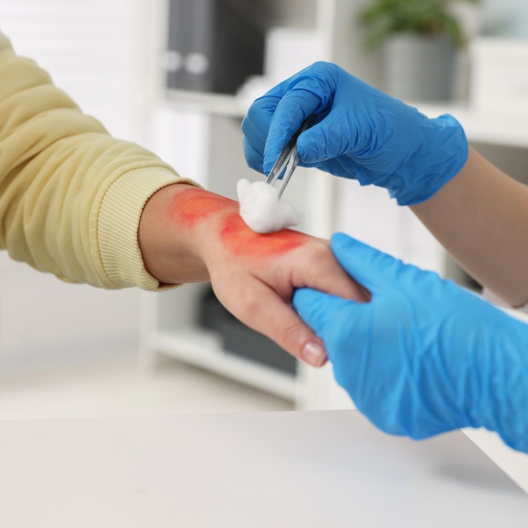Care of Minor Wounds & Burns treatment at Renewed Health and Wellness in Prospect, Connecticut