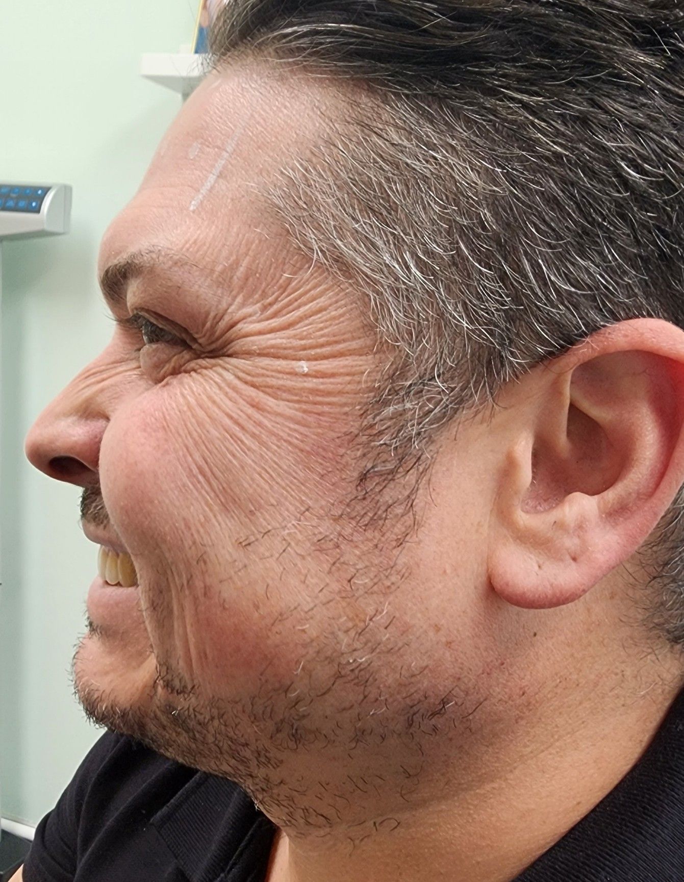 Before treatment result at Renewed Health and Wellness