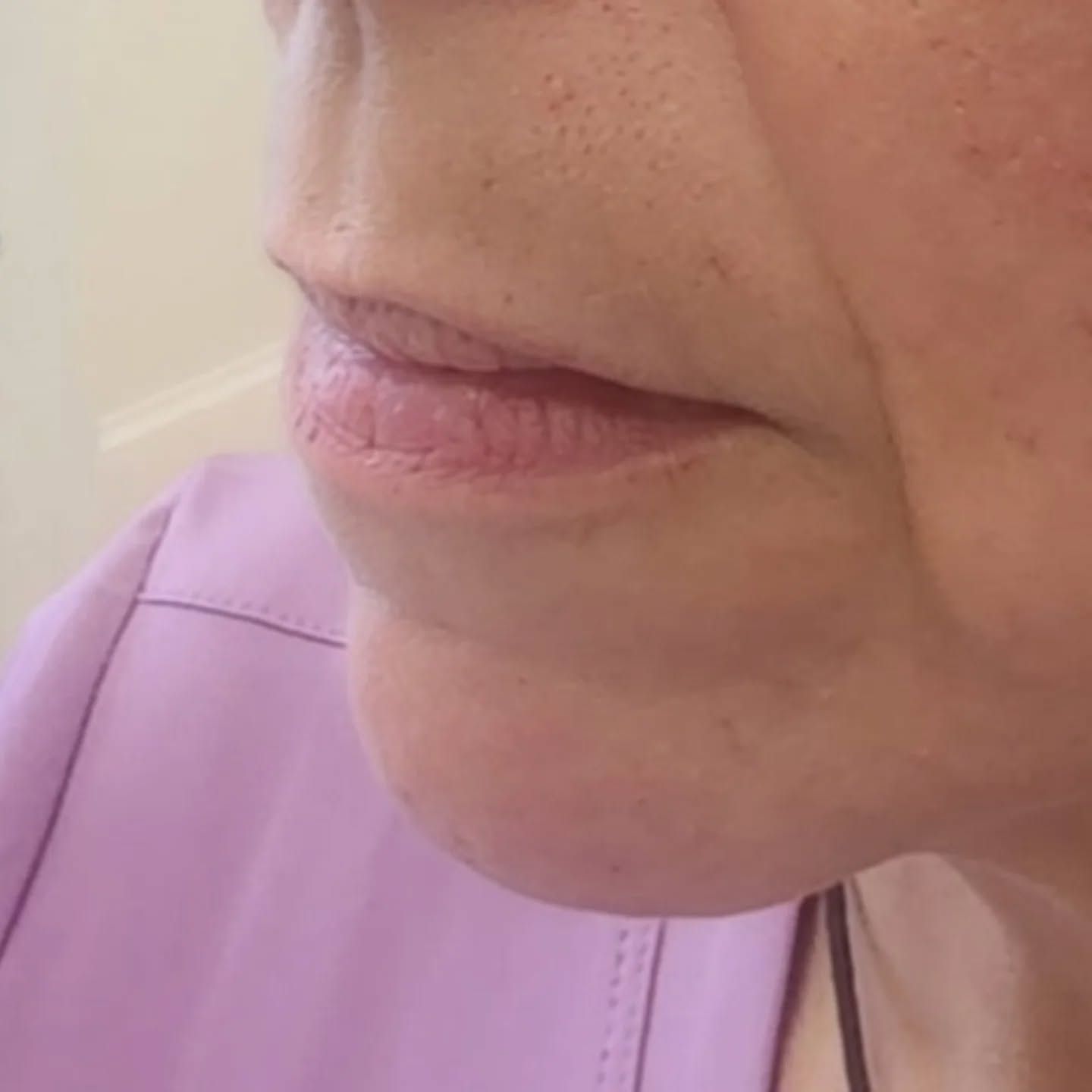 Before treatment result at Renewed Health and Wellness