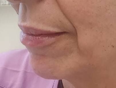 After treatment result at Renewed Health and Wellness