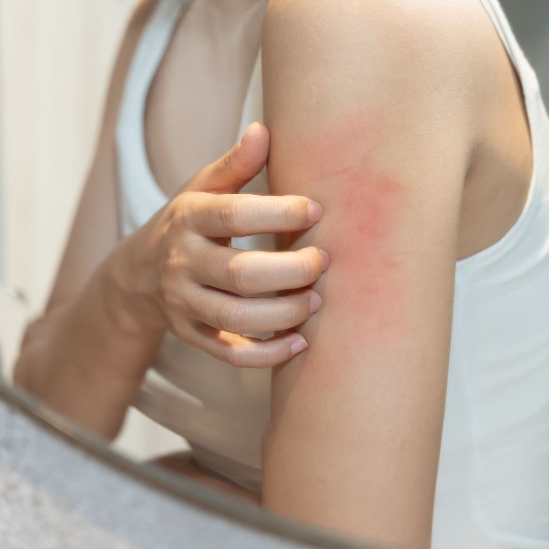 Skin Rash & Skin Infections treatment at Renewed Health and Wellness in Prospect, Connecticut