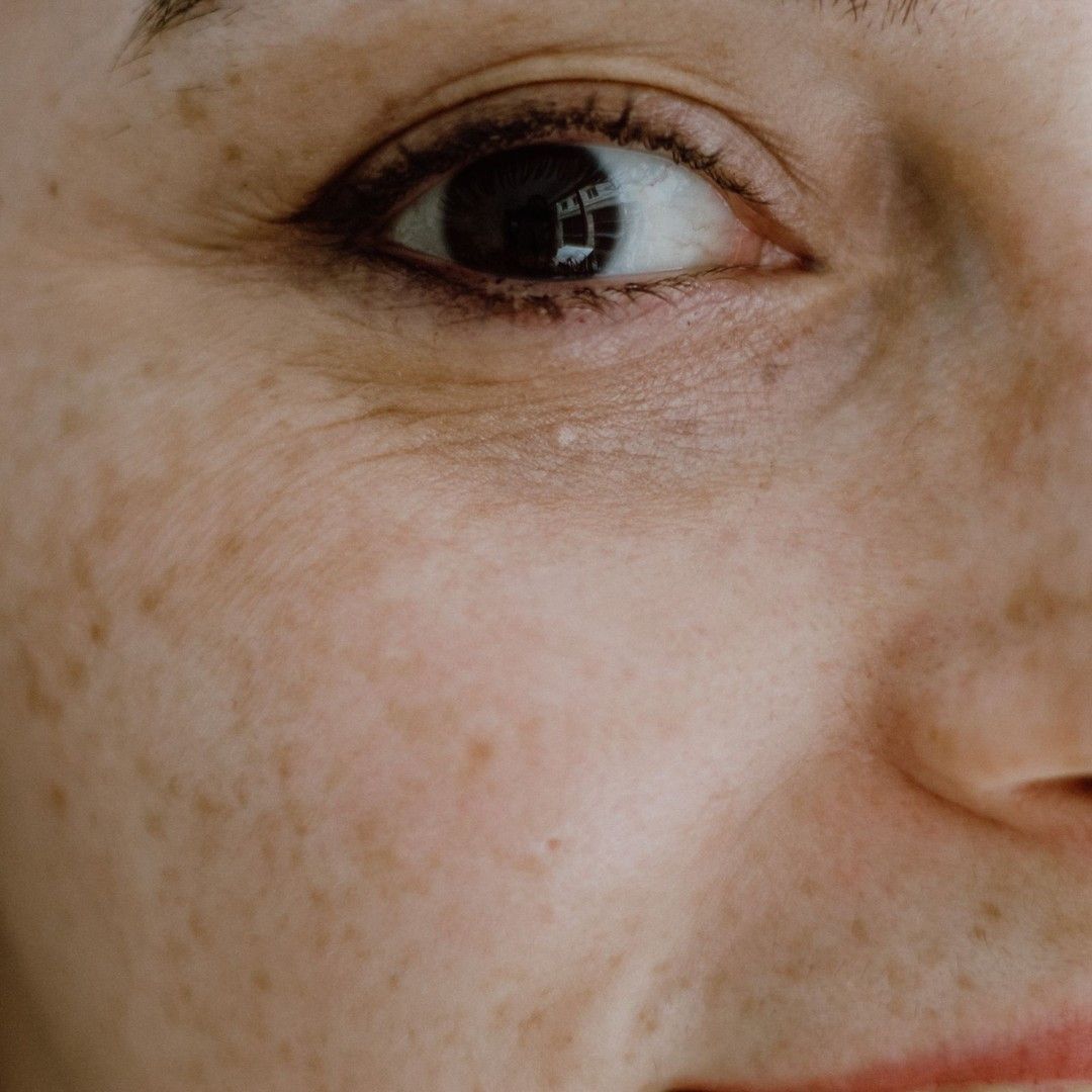 Close-up of facial pigmentation at Renewed Health and Wellness in Prospect, Connecticut