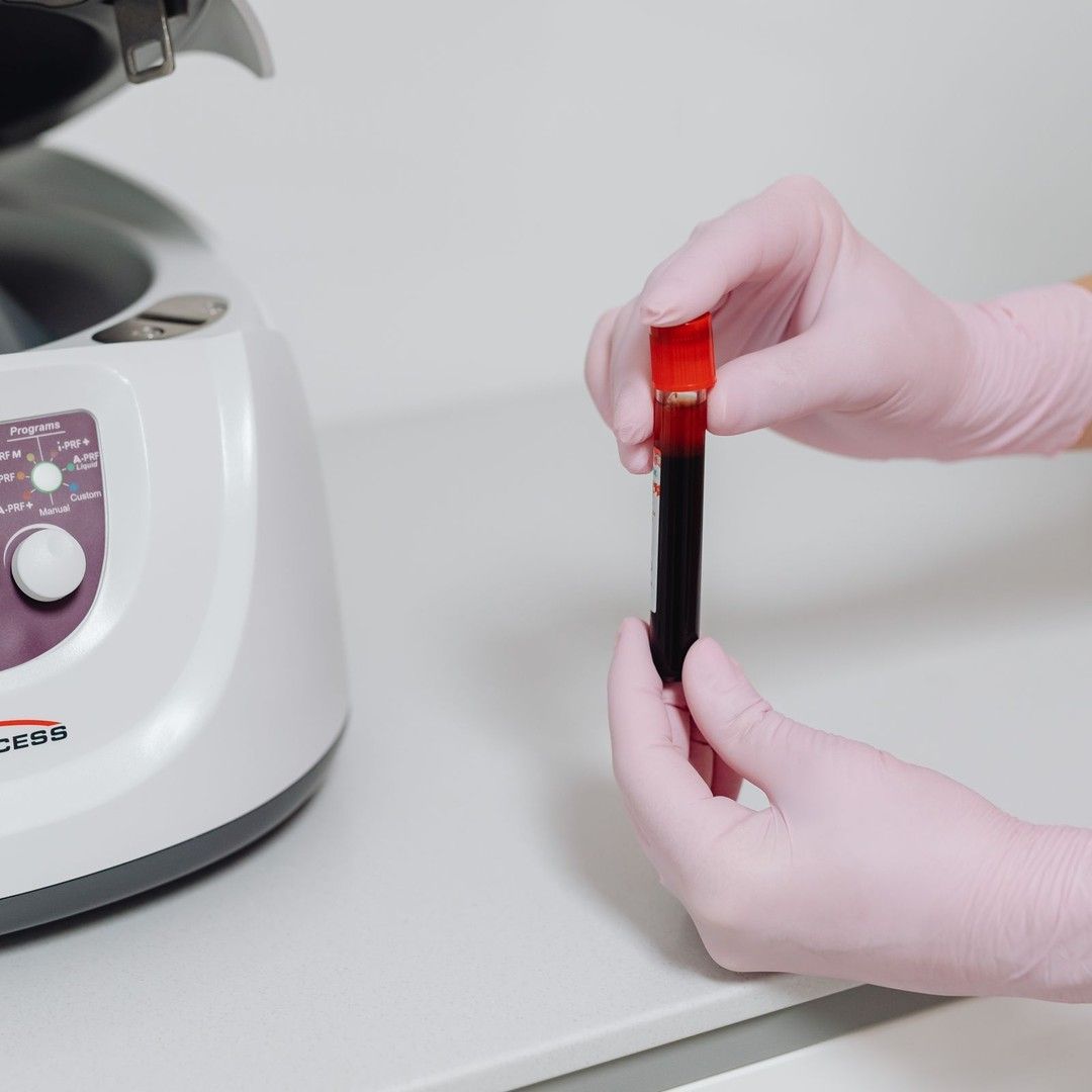 A blood sample being prepared for PRF at Renewed Health and Wellness in Prospect, Connecticut