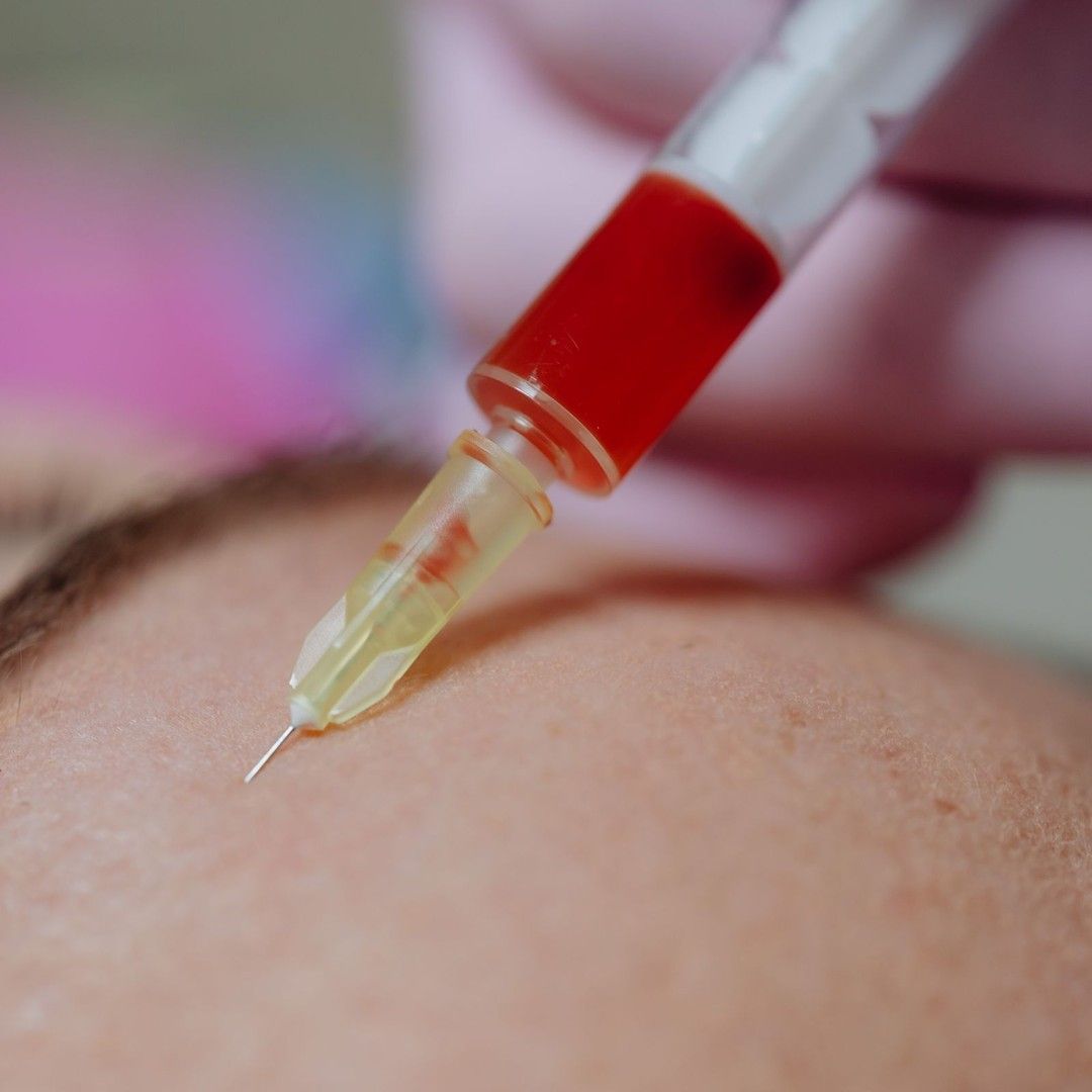 PRF being injected during a facial treatment at Renewed Health and Wellness in Prospect, Connecticut