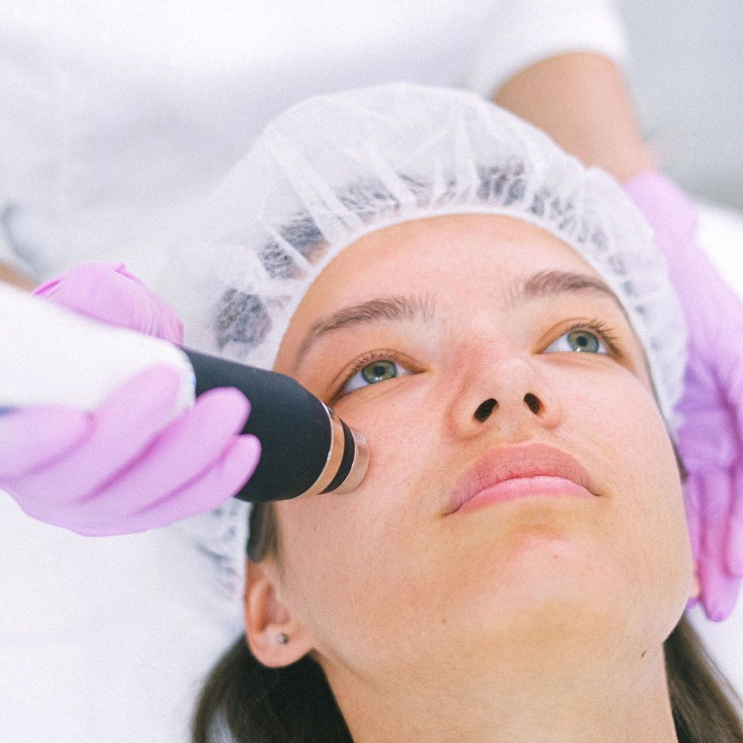RF microneedling handpiece treating the cheek at Renewed Health and Wellness in Prospect, Connecticut