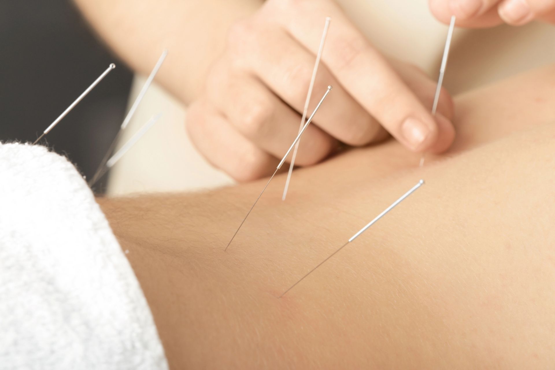 Weight Loss Acupuncture in Sheboygan, WI Weight Loss Acupuncture in Sheboygan, WI