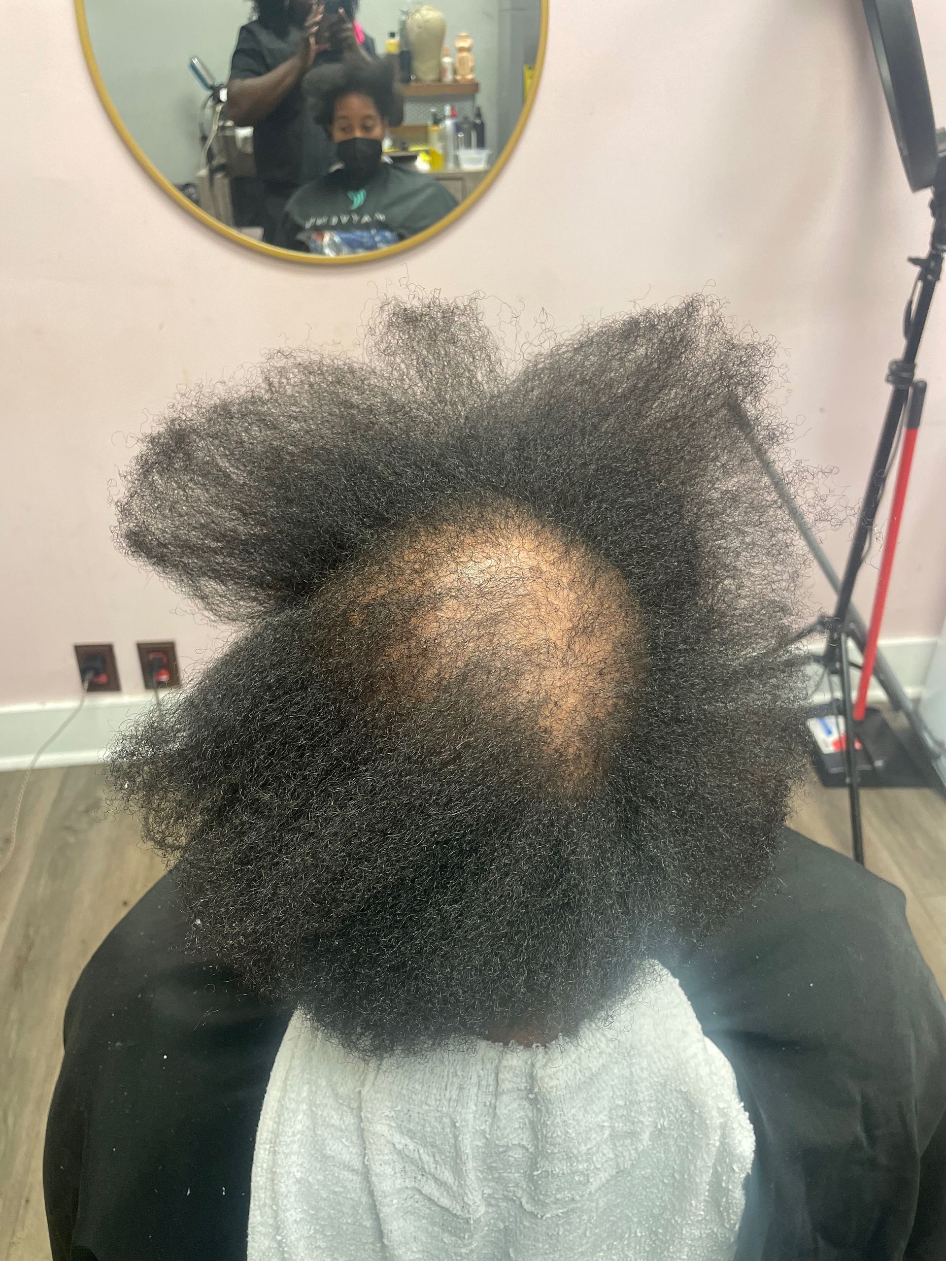 Women Hair Loss