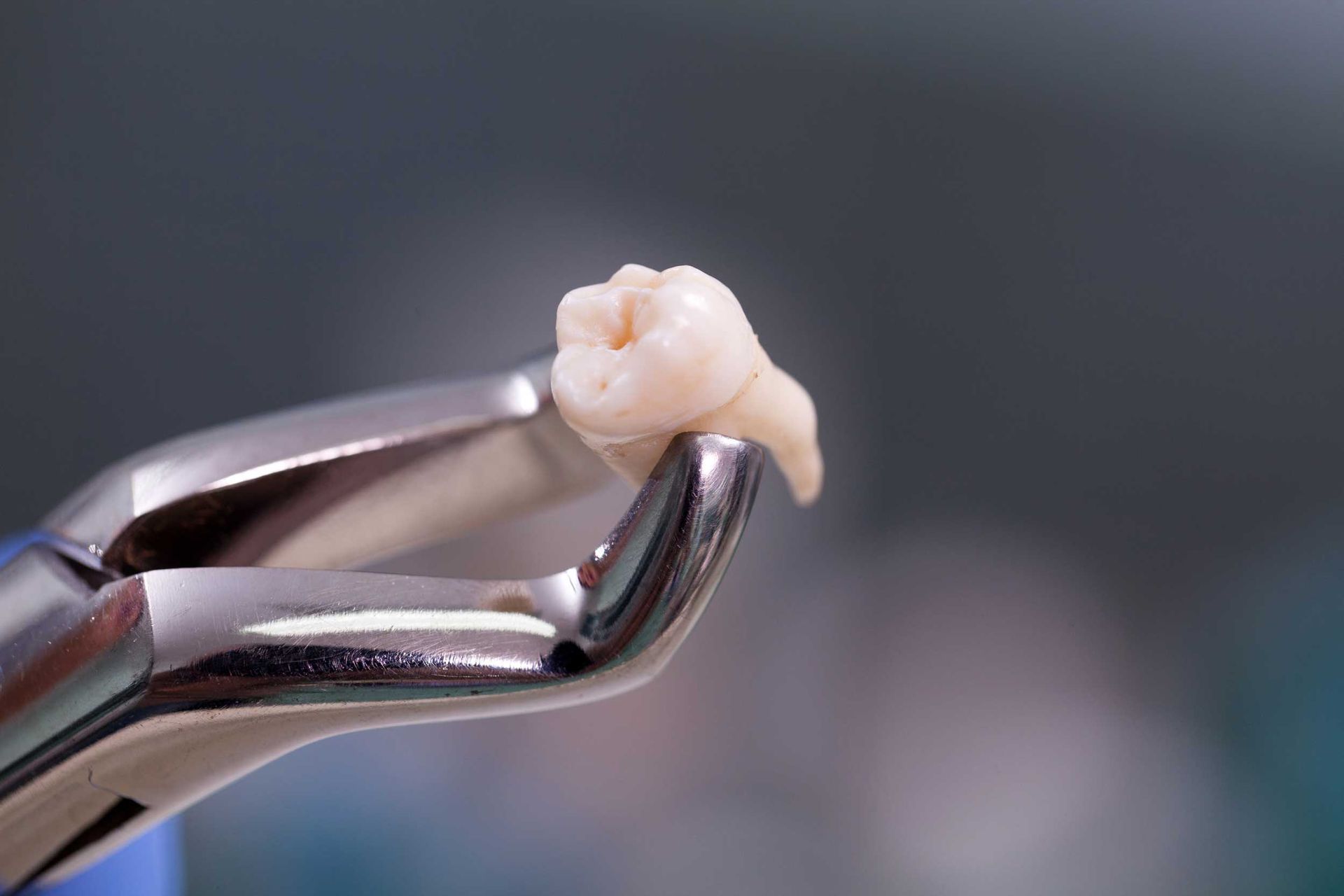 An extracted molar tooth held with dental forceps in a close-up view