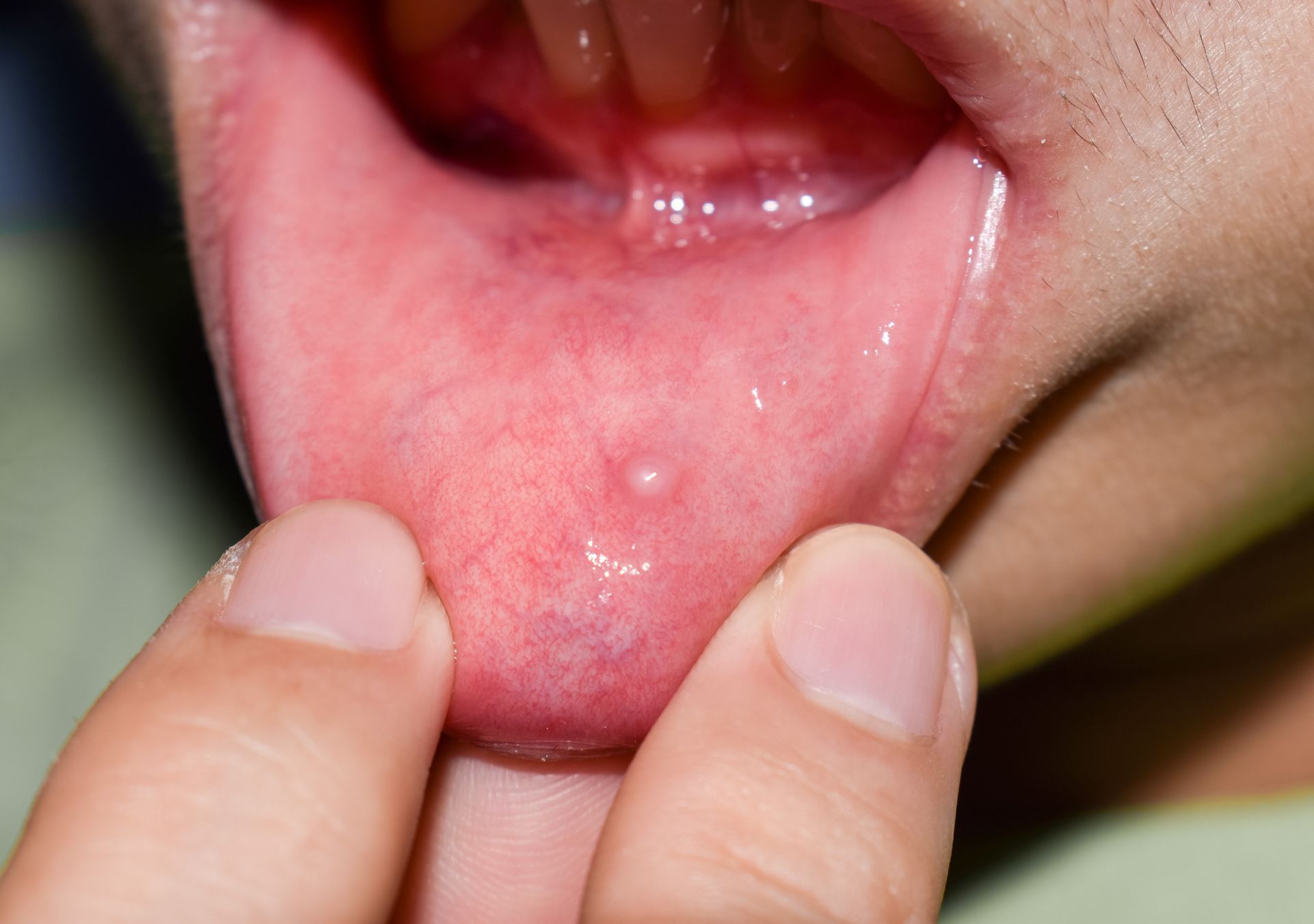 Il mucocele