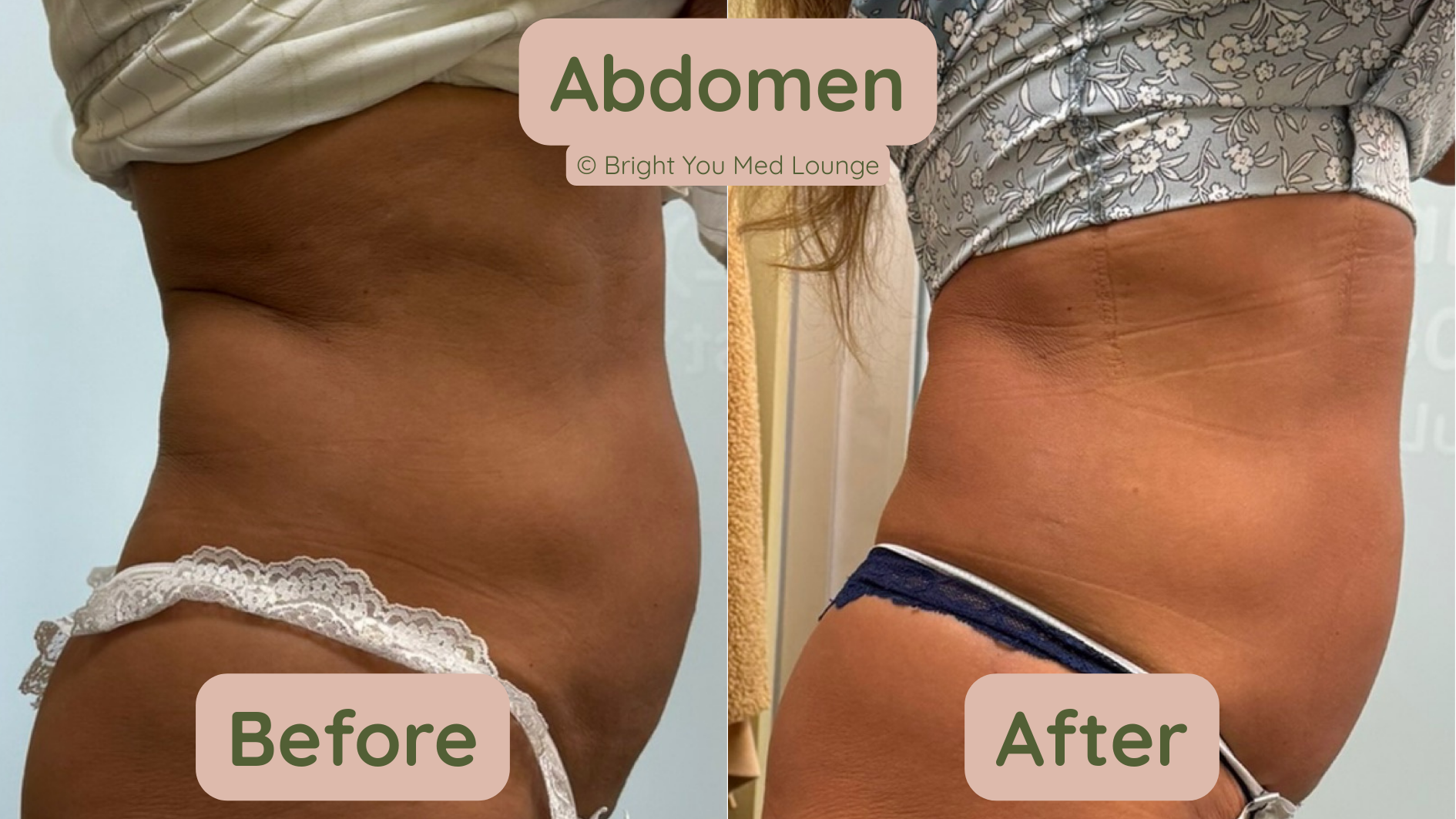 Side-by-side abdomen before and after photos, showing a flatter stomach after treatment.