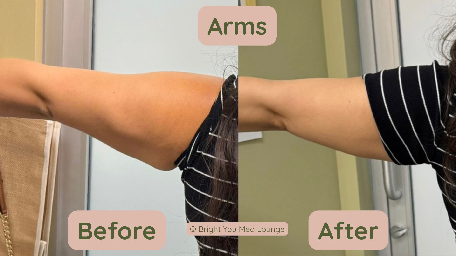 Side-by-side arm comparison labeled Before and After, showing a black wrap on the arm
