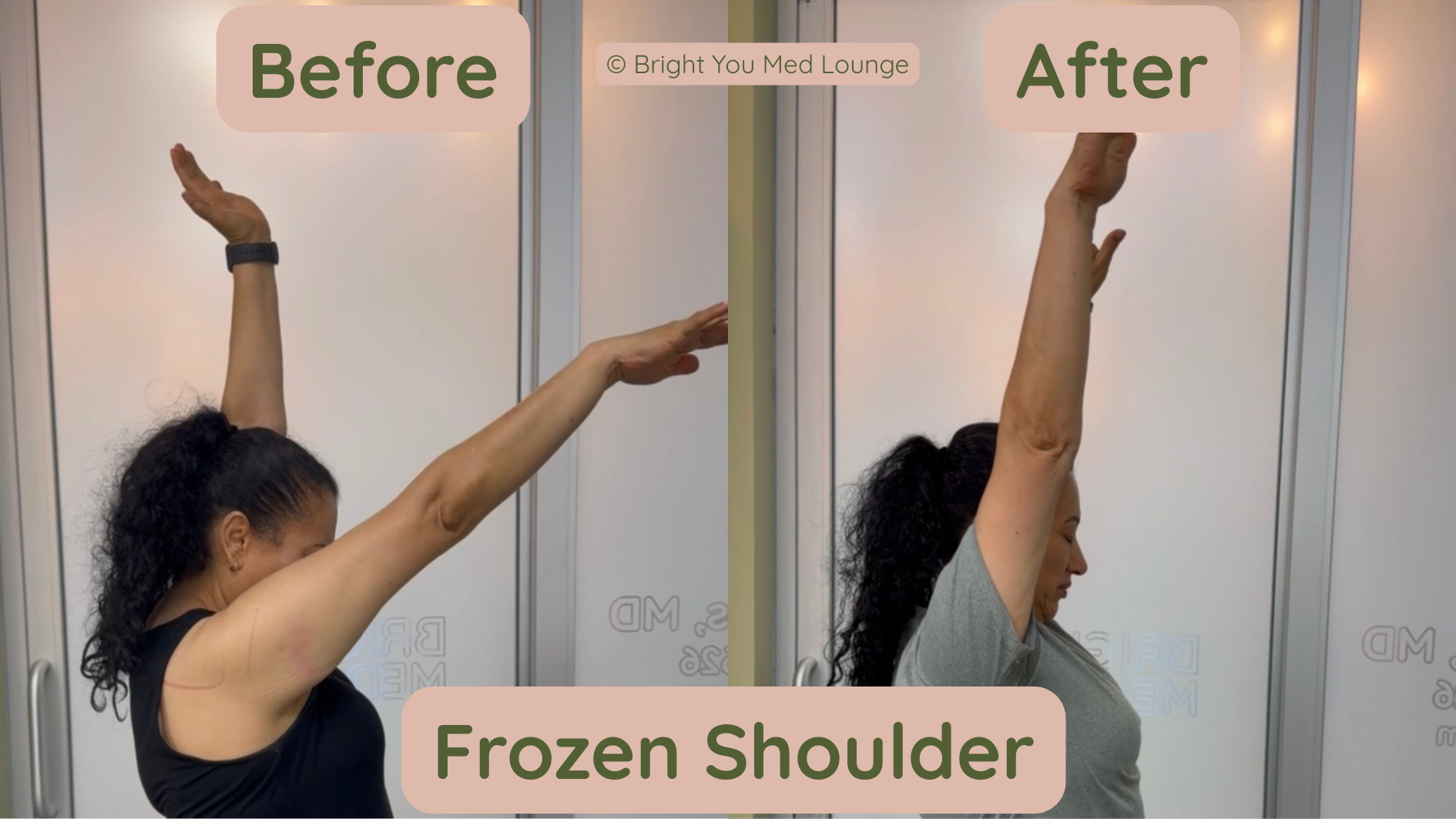 Before-and-after frozen shoulder exercise: arm raised from bent to overhead, with captions.