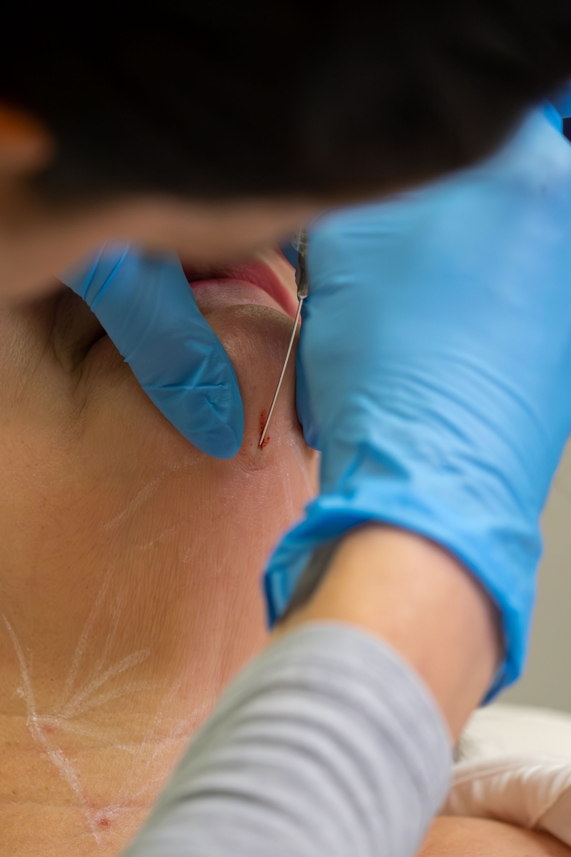 Gloved hands perform a neck injection on a seated person’s bare upper back and shoulder