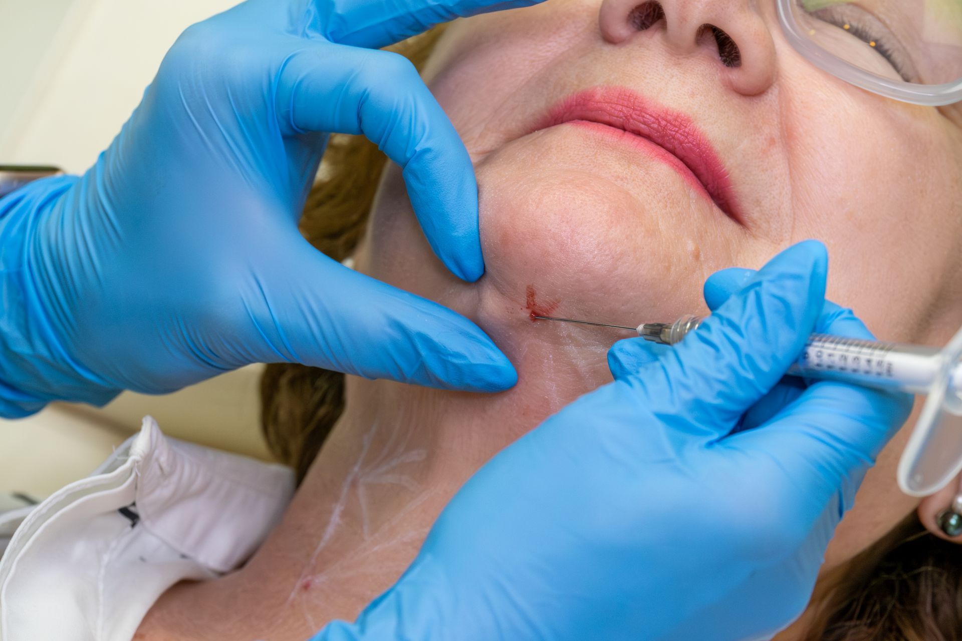 Gloved hands inject a woman’s chin with a syringe during a cosmetic procedure.