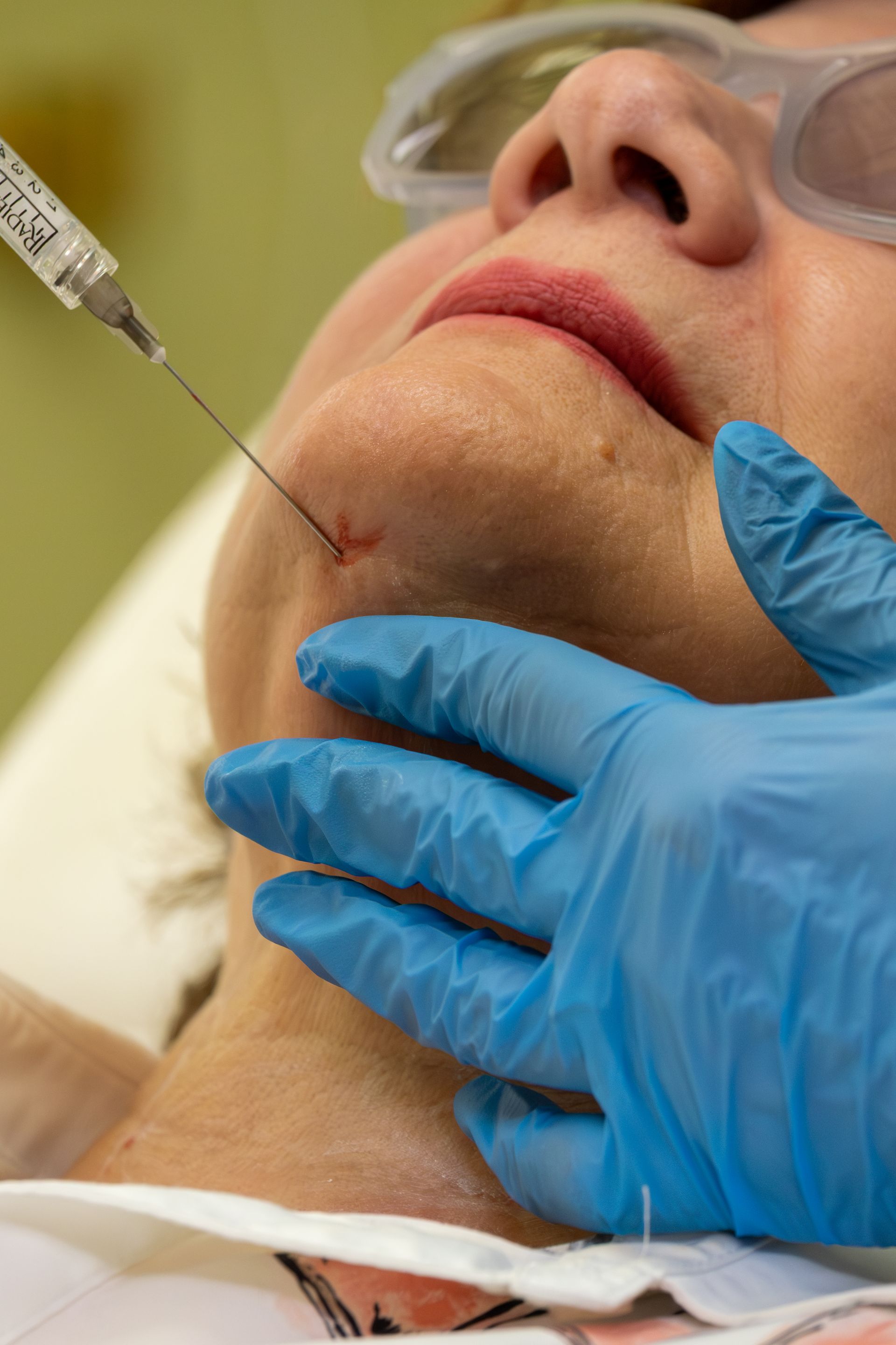 Gloved hands inject filler into a patient’s chin during a cosmetic procedure