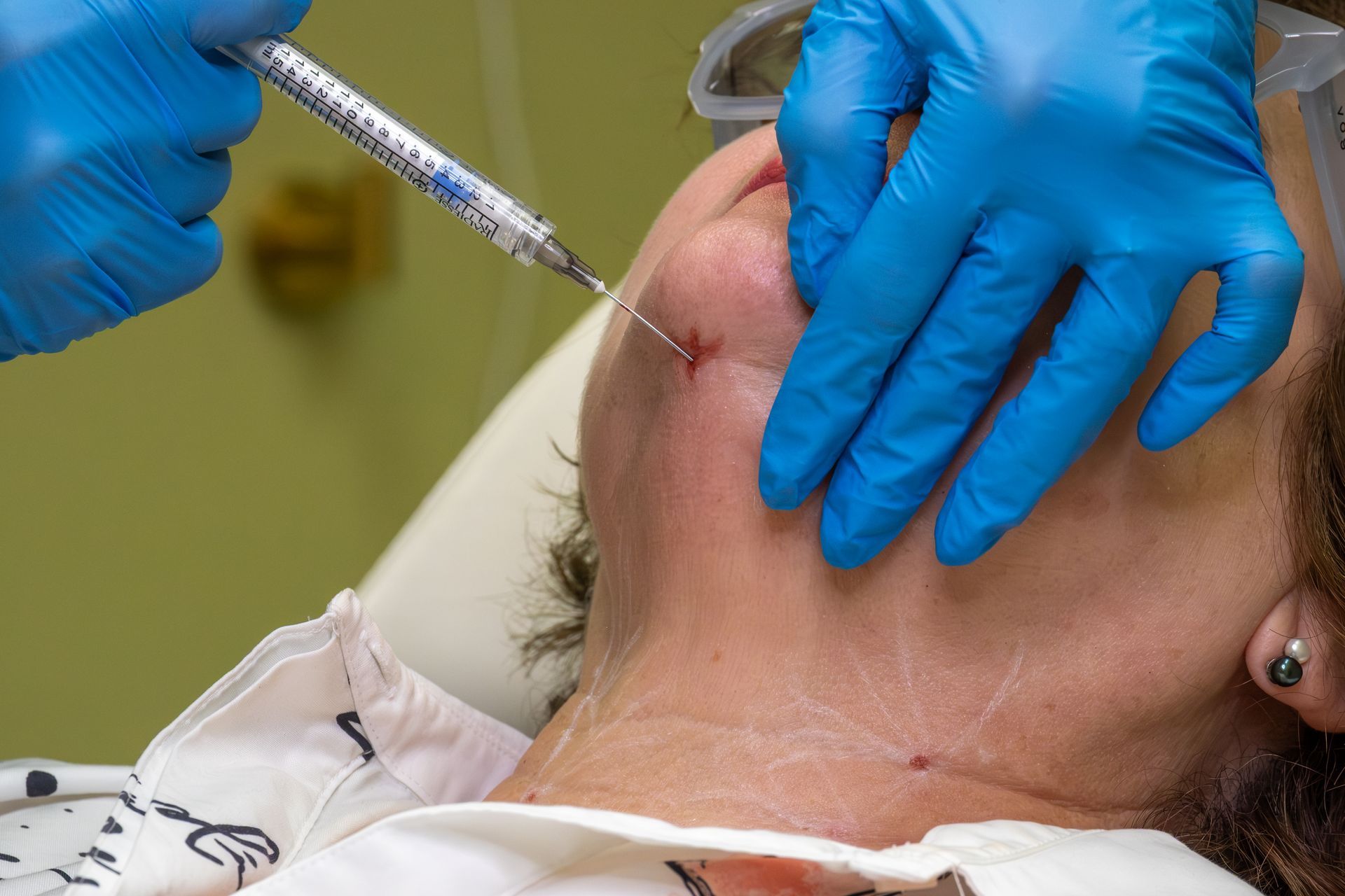 Gloved hands inject filler into a reclining patient’s lips in a clinical setting