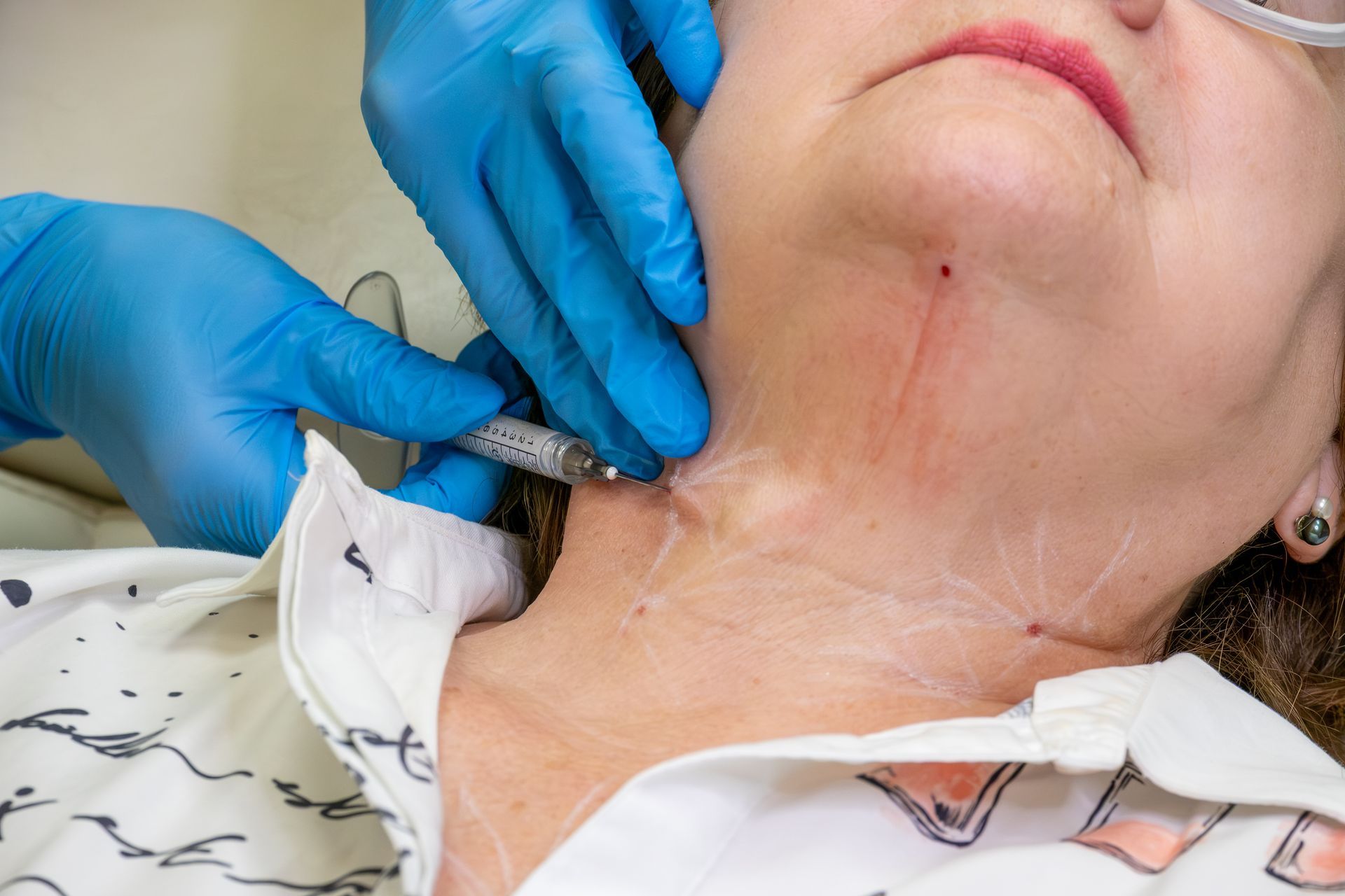 Gloved hands inject a woman’s neck with a syringe during a medical procedure