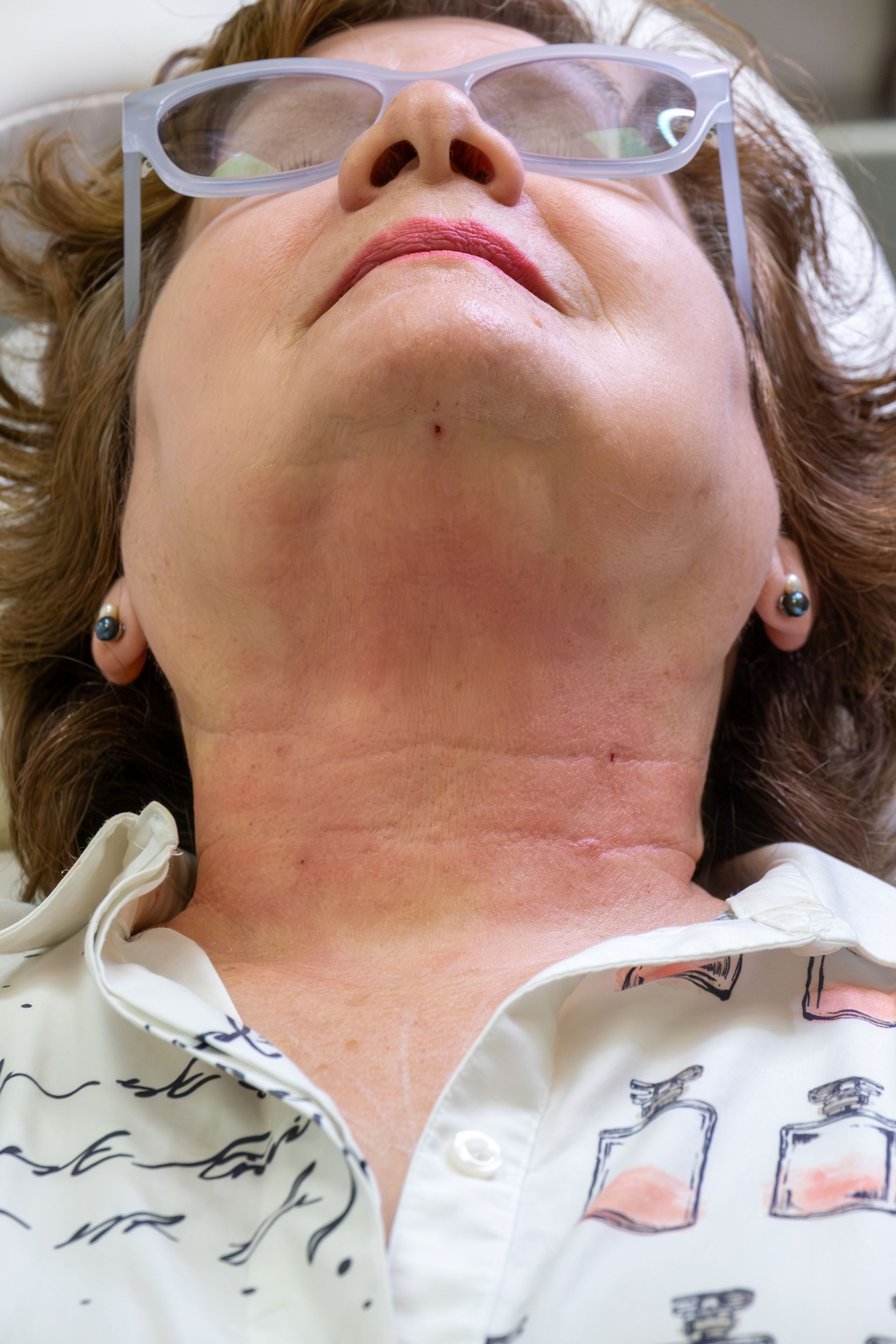 Close-up of a person with glasses looking upward, wearing a white patterned shirt and visible neck redness.