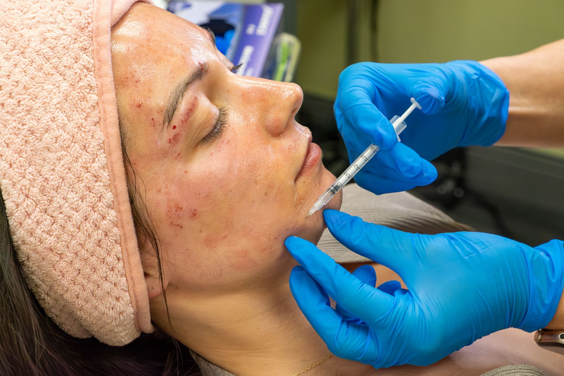Gloved practitioner injecting treatment into a patient’s cheek with a syringe in a clinical setting