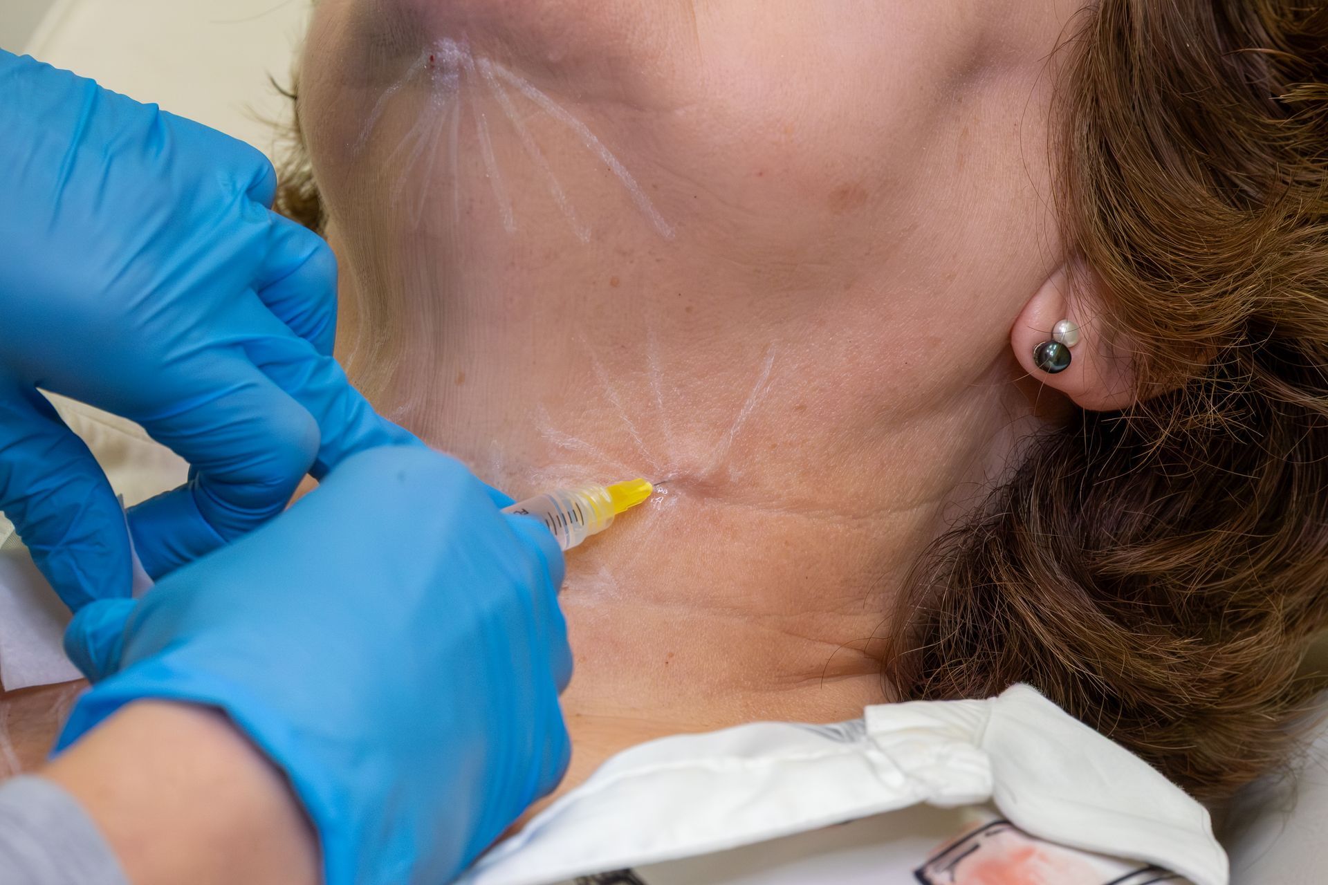 Gloved hands inject a syringe into the side of a woman's neck during a medical procedure