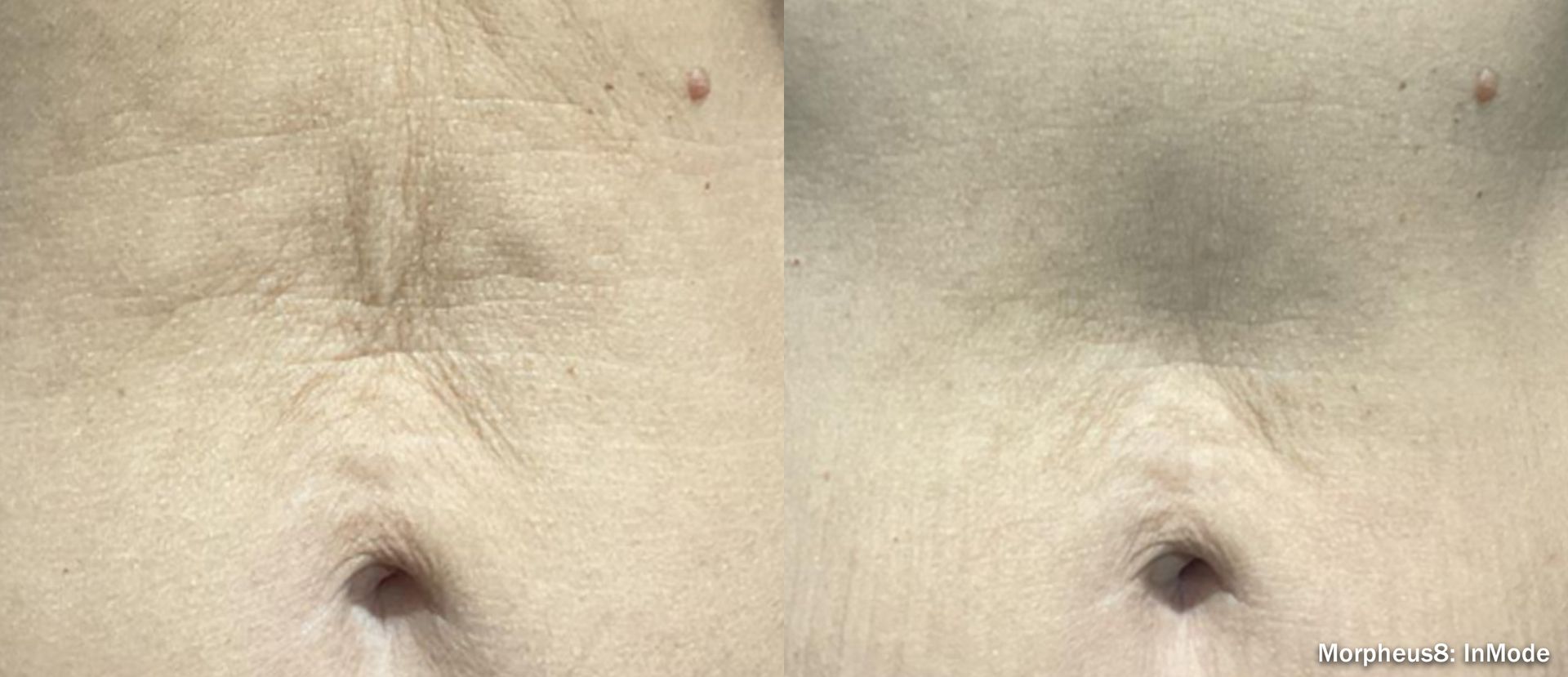 Close-up of a pale abdomen with two surgical scars near the navel and lower belly