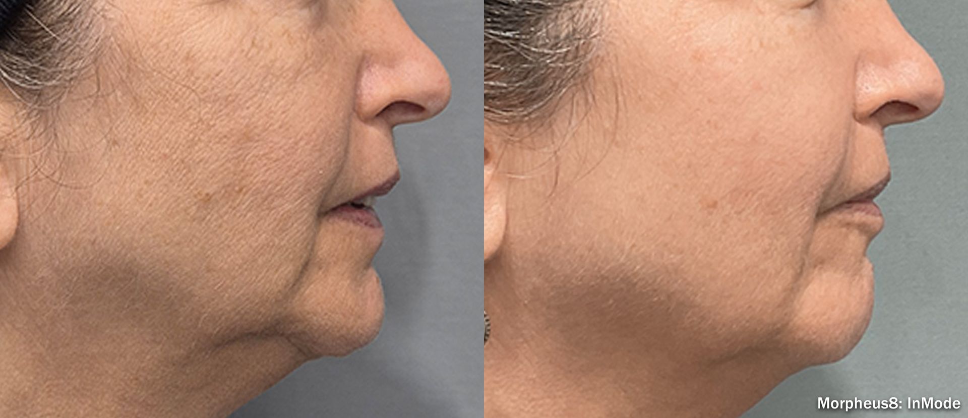 Side-by-side profile photos of a person’s face, showing the chin and jawline before and after treatment.