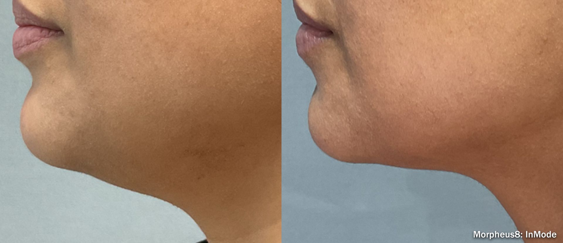 Side-by-side profile close-ups of a chin and jawline, showing a before-and-after comparison.