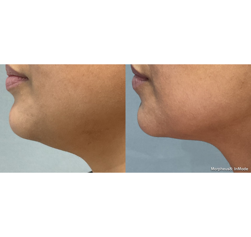 Side-by-side close-up profile views of a person’s chin and jawline before and after treatment