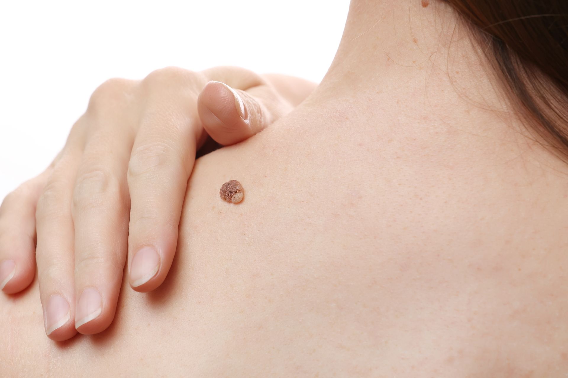 Hand touching a small mole on the shoulder blade
