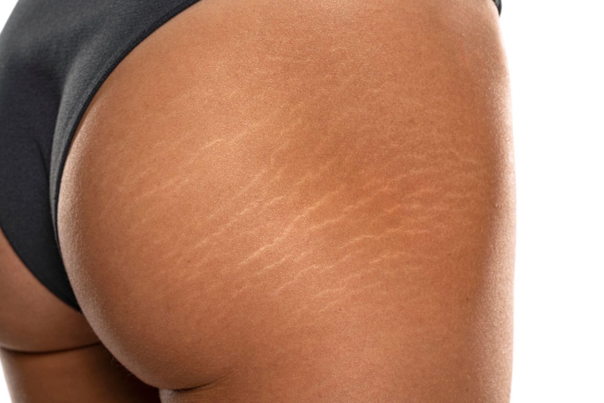 Close-up of tan skin with visible stretch marks on a rounded hip or thigh, wearing black underwear
