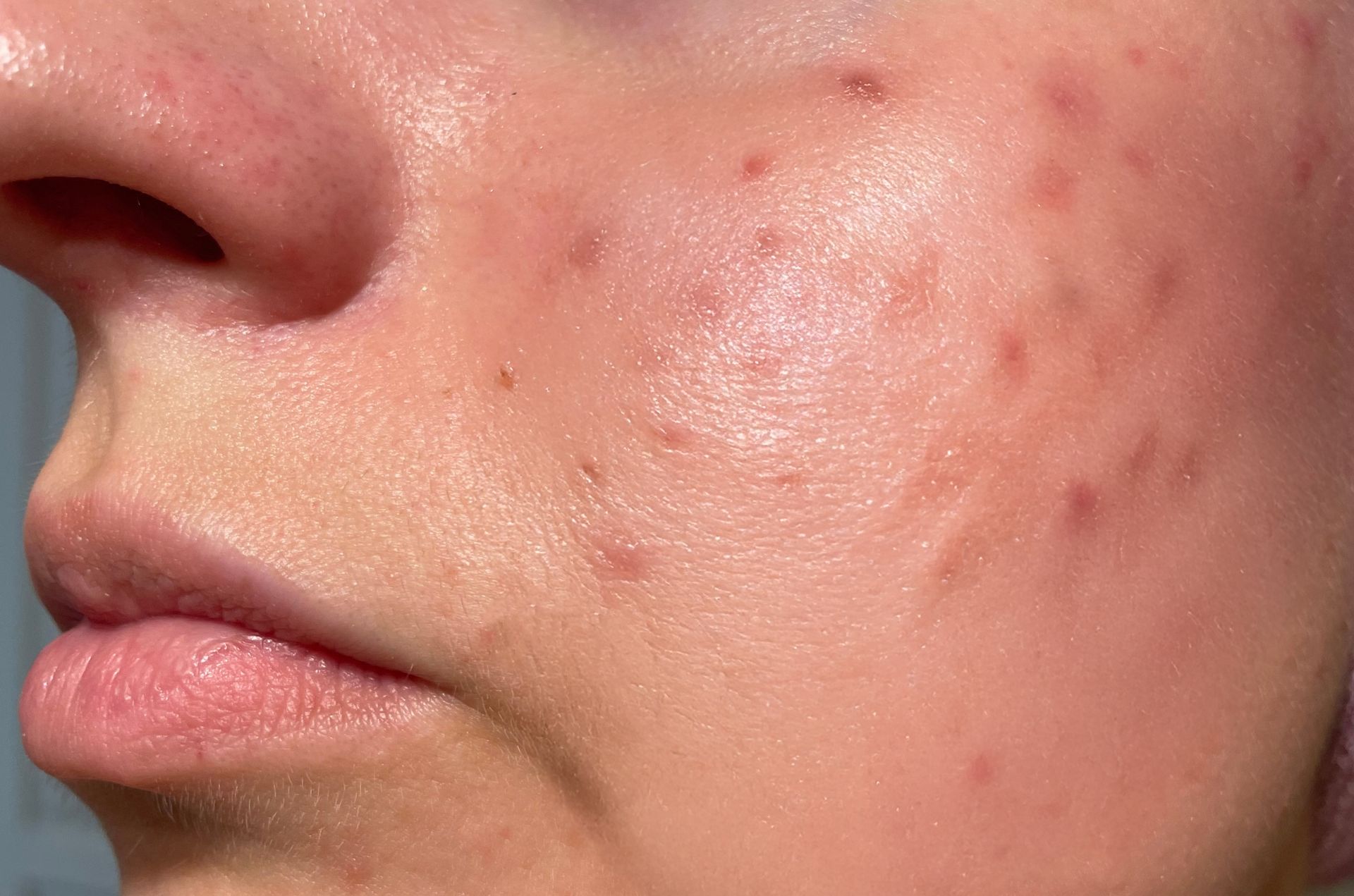 Close-up of a cheek with acne blemishes and red spots on skin