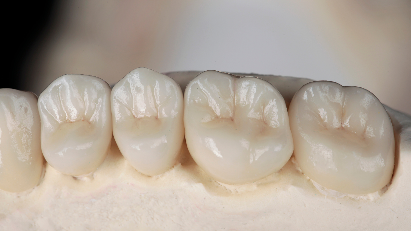 Close-up of a row of four white dental crowns on a plaster model, showing detailed tooth anatomy.