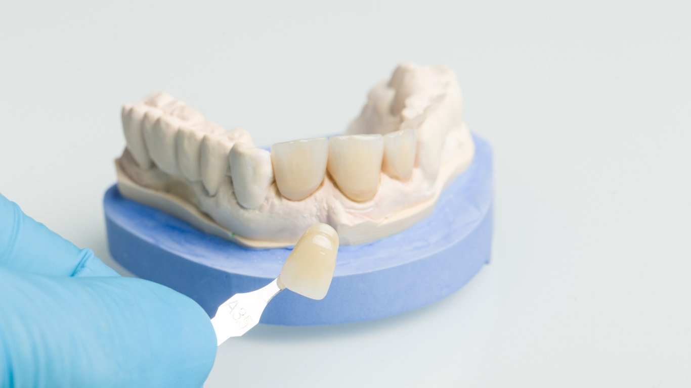 Hand in blue glove holds a dental veneer near a plaster dental mold with fabricated teeth.