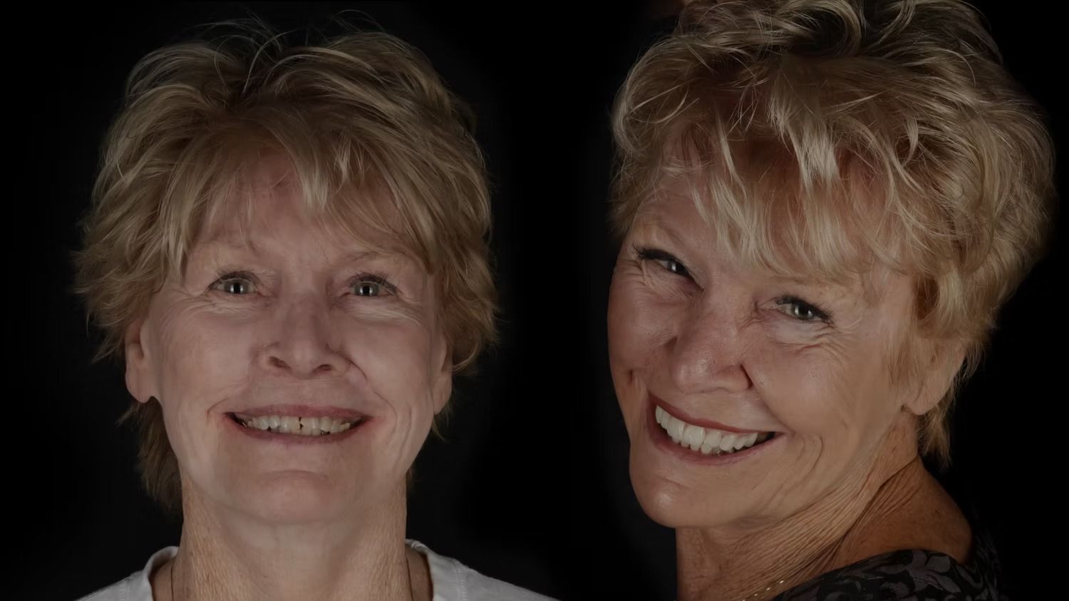 Woman with short blonde hair; before and after photos showing improved smile.