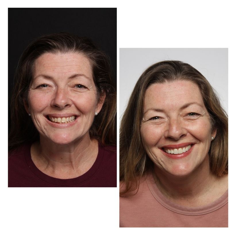 Side-by-side portraits: older woman smiling, before and after a cosmetic procedure.