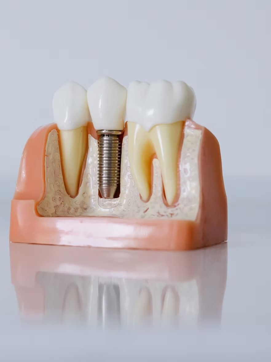Dental model showing a tooth implant between two natural teeth, all in a pink gum model on a white surface.