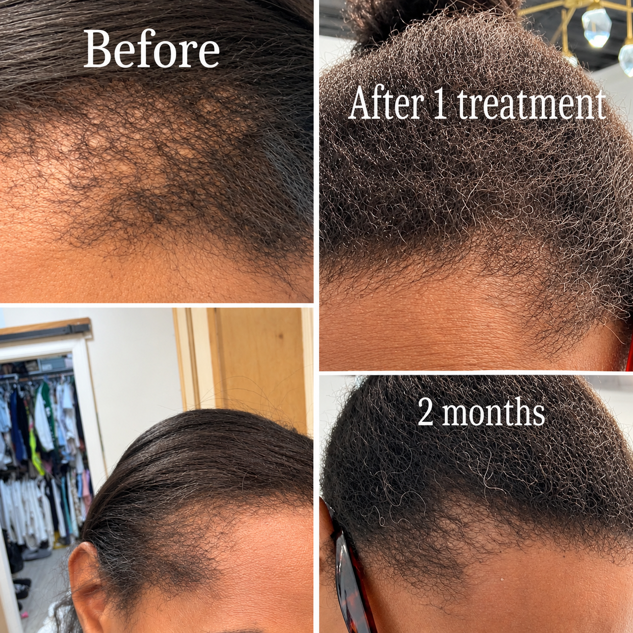 Collage showing scalp hair growth progress labeled before, after 1 treatment, and 2 months.