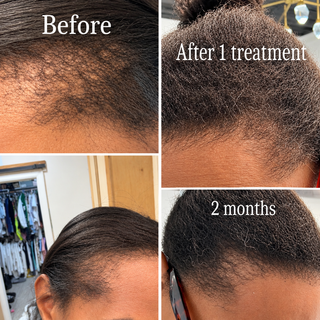 Collage showing scalp hair growth progress labeled before, after 1 treatment, and 2 months.