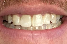 A close up of a man 's teeth with a beard.