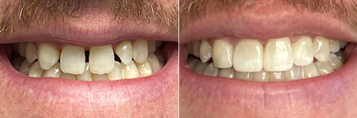 A before and after picture of a man 's teeth.